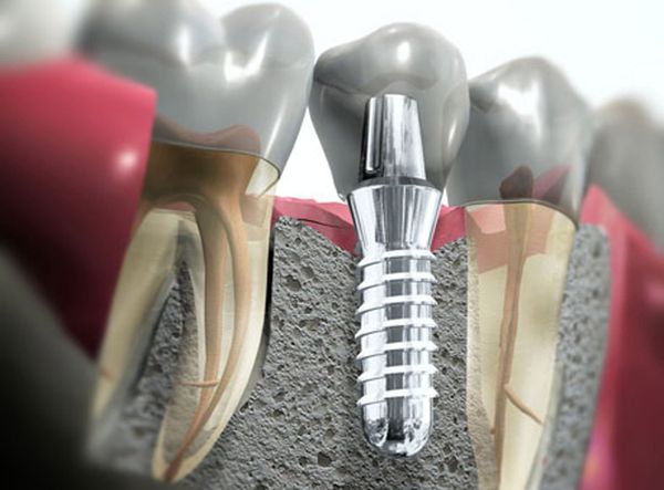 способы имплантации зубов