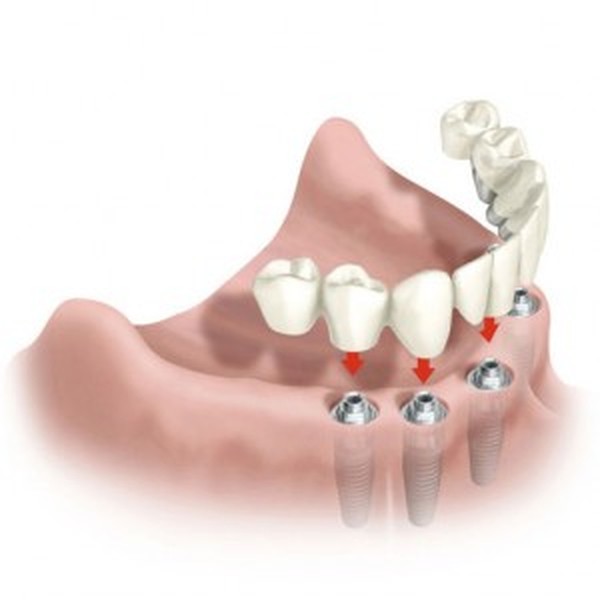 имплантация зубов иваново цены