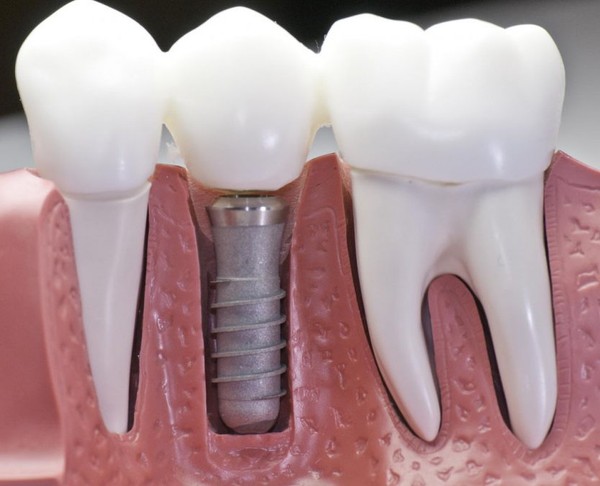 сколько стоит имплантация зуба под ключ цена