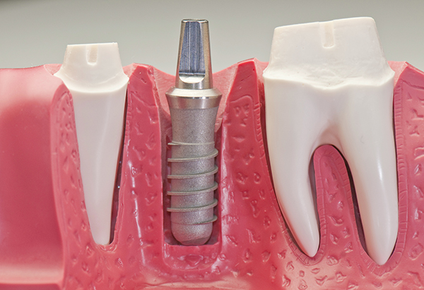 как вживляют зубной имплантант