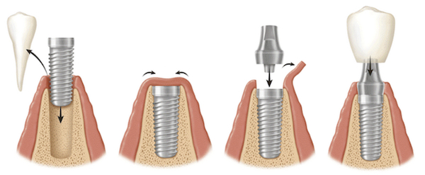 как вживляют зубной имплантант