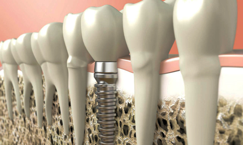 технология установки имплантов зубов 