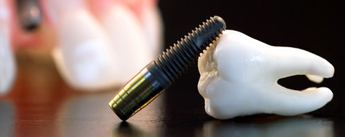 плюсы и минусы имплантации зубов