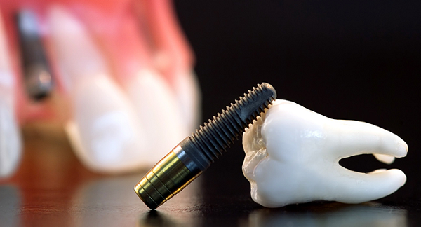 современные методы имплантации зубов