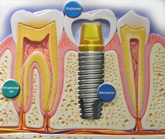 стадии имплантации зубов
