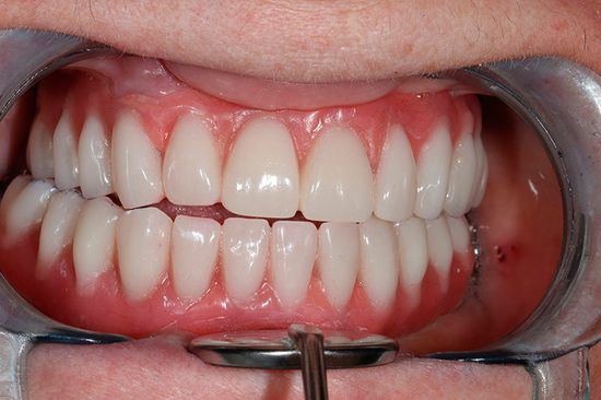 качественная имплантация зубов