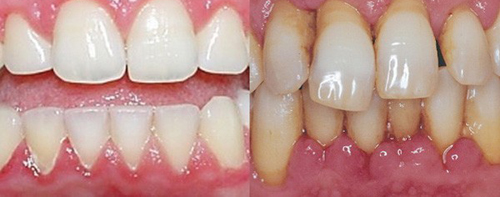имплантация зубов при пародонтите