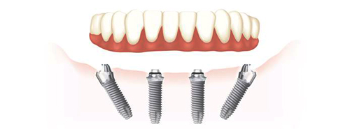 одномоментная имплантация зубов