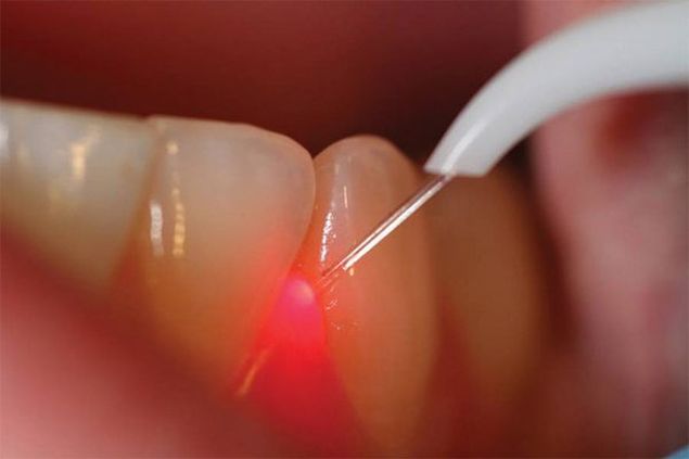 лечение лазером в стоматологии