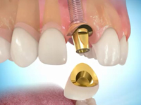 стоимость установки импланта зуба