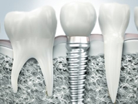 методика имплантации зубов