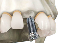технология установки имплантов зубов