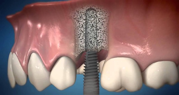 компрессионная имплантация зубов
