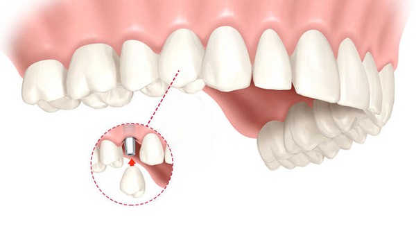 имплантация зубов с коронкой