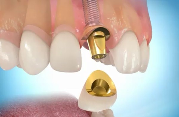 из какого материала делают зубные импланты