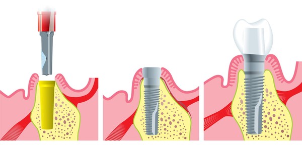 возраст имплантации зубов