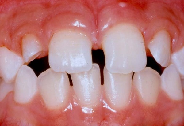 аномалии зубов и зубных рядов