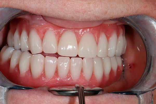 зубные сегменты