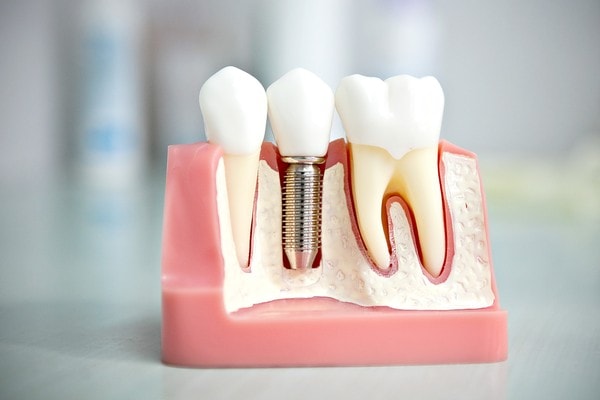 имплантация зубов дешево акции