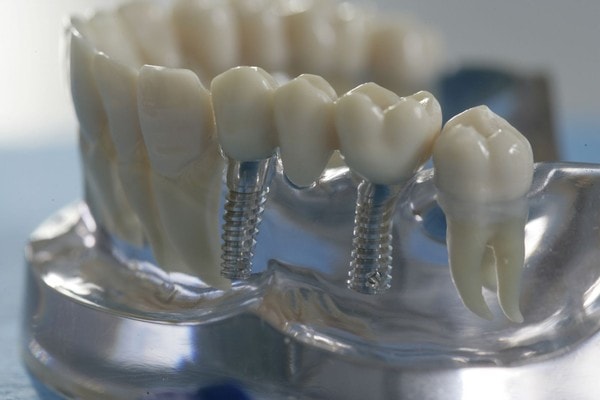 имплантация зубов дешево акции