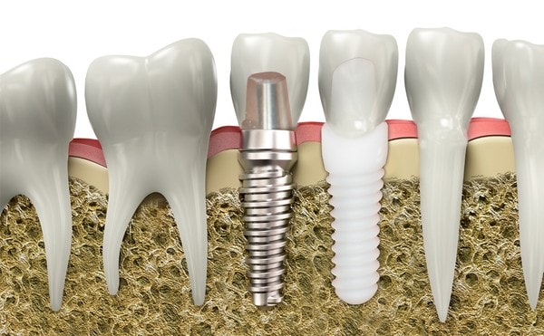 биосовместимые материалы в стоматологии