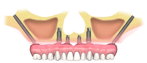 Базальный метод имплантации зубов