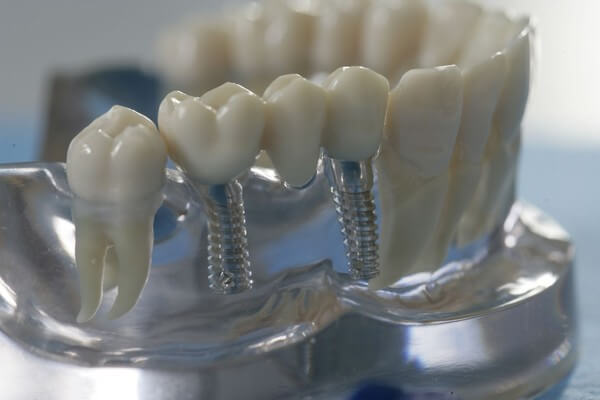 мостовидные протезы ортопедическая стоматология