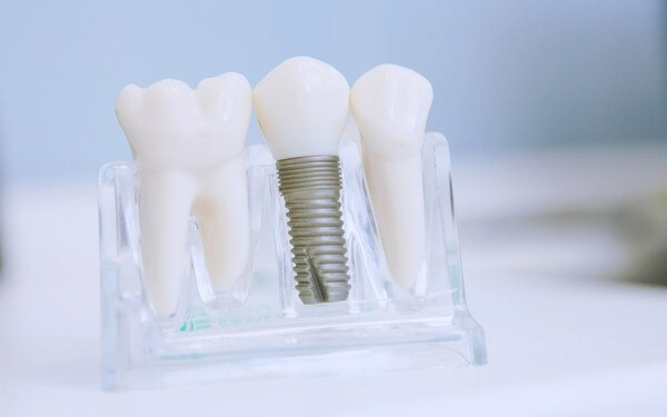 мостовидные протезы ортопедическая стоматология