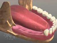 падение минерализации челюстной костной ткани