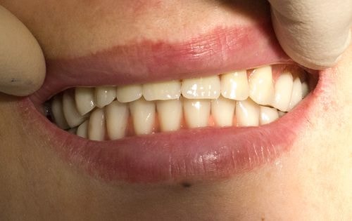 зубы в ортопедической конструкции
