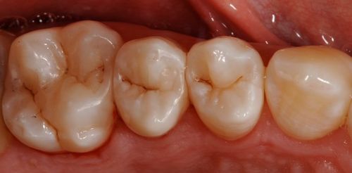 окклюзионная плоскость зубов