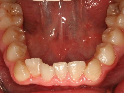 окклюзионная плоскость зубов