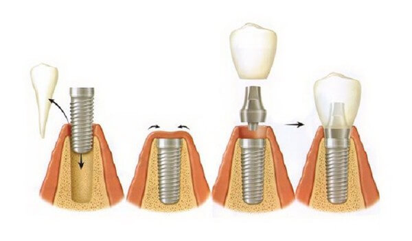 Базальная имплантация зубов в клинике доктора Кизима