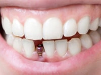 варианты имплантации зубов