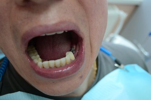 имплантация зубов сколько времени занимает