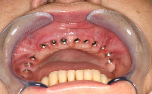 имплантация зубов всей челюсти