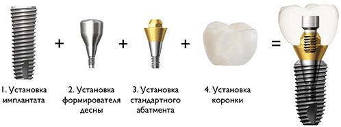 имплантация зубов в России