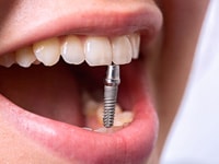 имплантация зубов в России