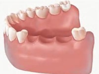 Какие импланты лучше ставить на жевательные зубы