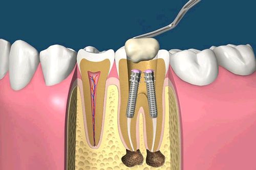 Виды имплантов в стоматологии