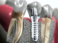 виды имплантов в стоматологии
