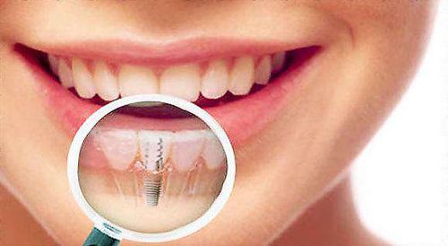 Какой имплант лучше поставить на передние зубы