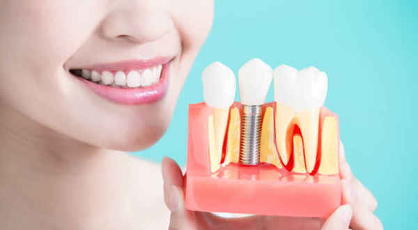 как долго приживаются импланты зубов