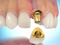 как устроен имплант зуба