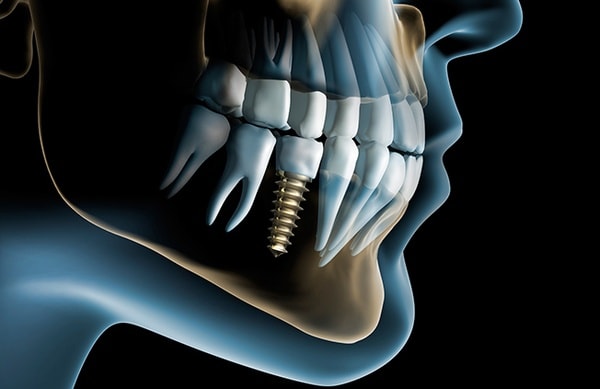 замещение дефектов зубных рядов