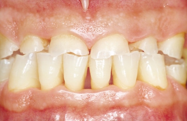 заболевания эмали зубов