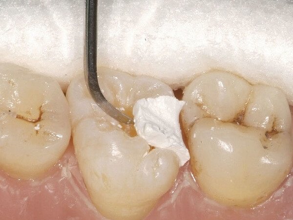 виды пломб для зубов