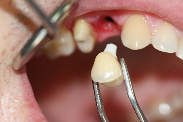 можно ли совмещать имплантат и родные зубы