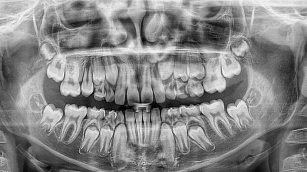как проходит имплантация зуба на нижней челюсти