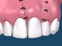 Сколько заживает десна после имплантации зуба